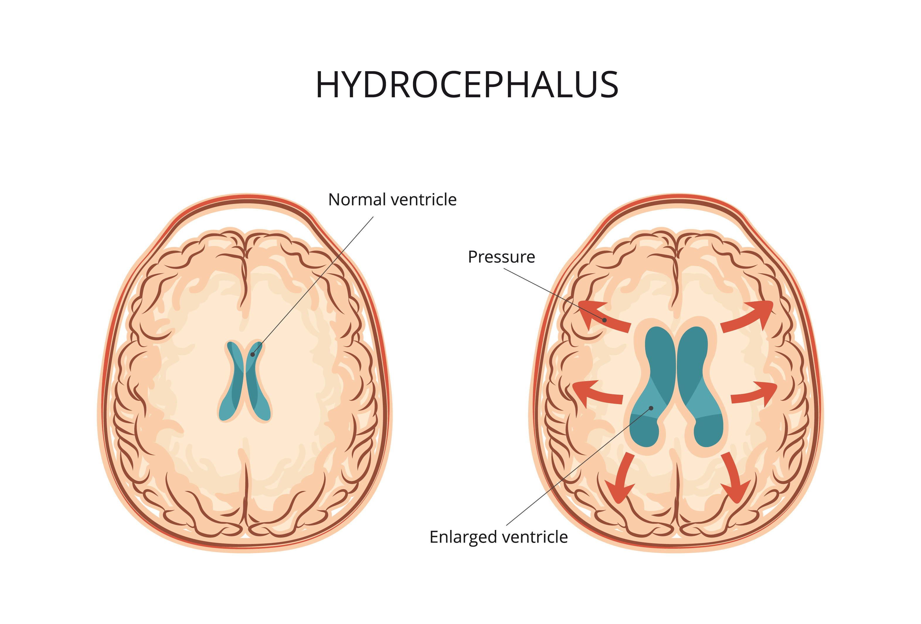 Причины гидроцефалии мозга. Клинические симптомы гидроцефалии. Наружная гидроцефалия головного мозга у ребенка. Водянка желудочков головного мозга. Внутренняя гидроцефалия.